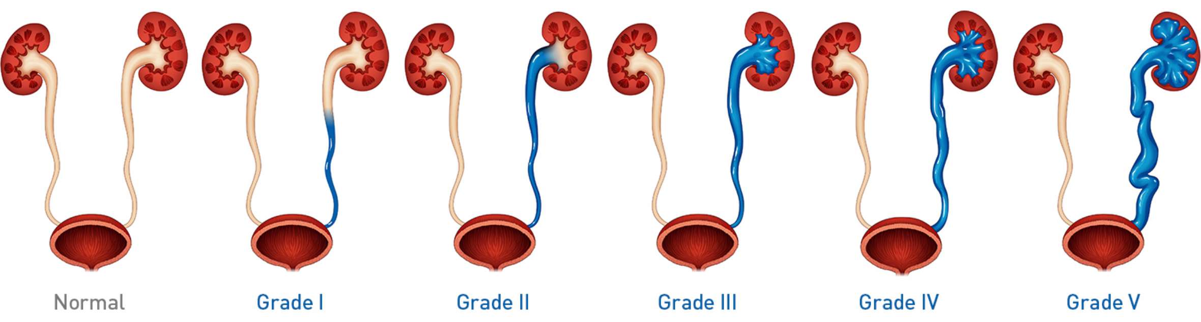 grades-of-vur-2